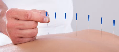 L'acupuncture pour perdre du poids : est-ce que ça marche ?