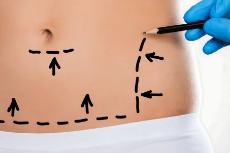 Tout savoir sur la liposuccion : principes, procédure, et résultats