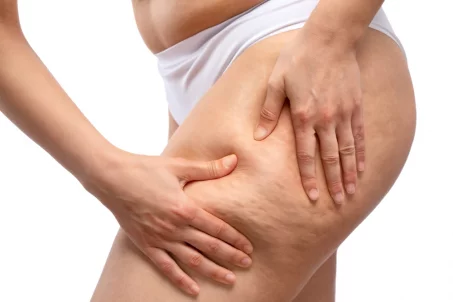 Cellulite : stratégies efficaces pour réduire son apparence