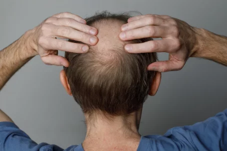 Tout savoir sur l'alopécie : comprendre, diagnostiquer et traiter la perte de cheveux