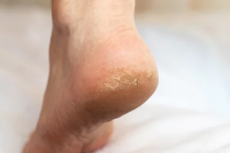 Comment soigner des pieds craquelés ?